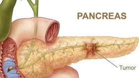 Combinacion de medicamentos para el cancer de pancreas