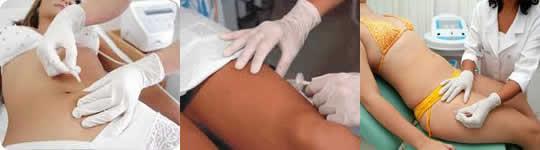 carboxiterapia