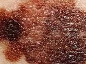 Científicos realizan mapa genético melanoma