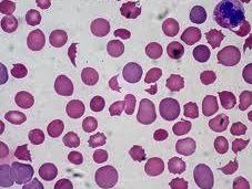 anemia hemolítica inmunitaria embarazo