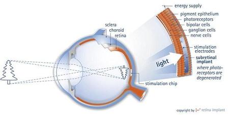 Implante electrónico devuelve la vista a ciegos por retinosis pigmentaria.