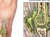 infecciones óseas pueden tratadas