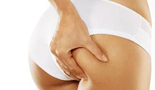 Qué es la celulitis y como evitarla