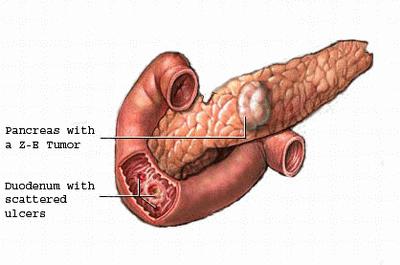 Una patología gastrointestinal poco común: síndrome de Zollinger-Ellison