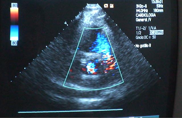 Resultado de la prueba de esfuerzo y el estudio ecocardiográfico, Doppler, espectral y color previo al Isostar Desert Marathon