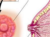 tipo cáncer mama poco común