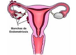 Relación entre endometriosis y cáncer de ovario