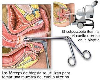 Citología Vaginal, ¿Cada cuánto tengo que hacerla?