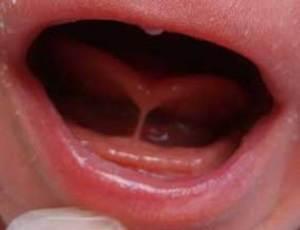 Frenillo anterior tipo 1 - anquiloglosia - lengua en forma de corazón