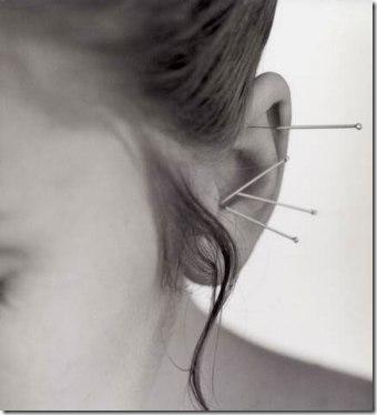 Tinnitus, Acupuntura Y Otros Tratamientos Utilizados
