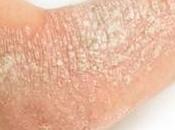 enfermedad piel molesta costosa: Psoriasis