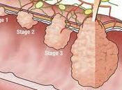 Para cáncer colorectal prevención clave