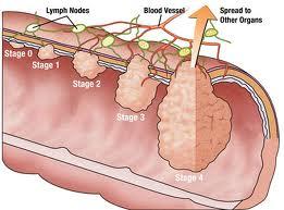 Para el cáncer colorectal la prevención es la clave