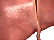 Formula para Dieta hígado graso esteatosis hepática