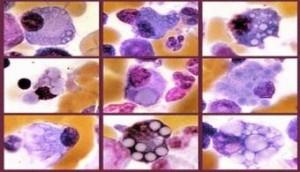 Desarrollan terapia para combatir enfermedades neurodegenerativas