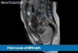 Por primera vez el nacimiento de un bebé capturado en película por resonancia magnética