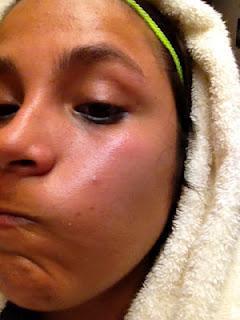 Bye bye Acné Bye bye Acné