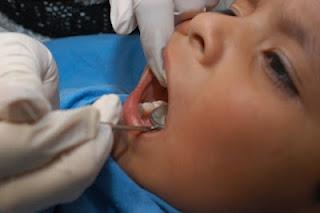 Prolongar uso de biberón y chupón provoca desde caries hasta deformaciones dentales: Especialista IMSS