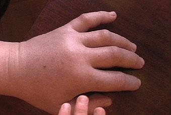 El Angioedema Hereditario