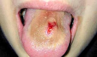 Piercing en la lengua, problemas, infecciones, riesgo.