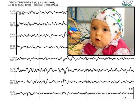 La enfermedad del sobresalto: mutaciones para la hiperplexia La enfermedad del sobresalto: mutaciones para la hiperplexia