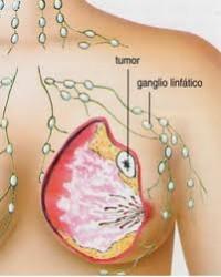 Un simple análisis de sangre podría predecir la supervivencia al cáncer de mama