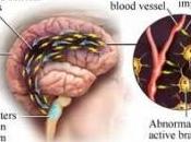 identificados nuevos genes relacionados migraña