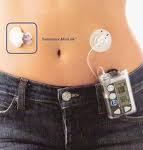 24 horas sin insulina con un páncreas artificial