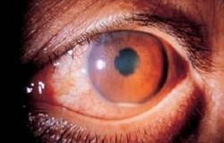 ¿Qué es el Síndrome de Behcet?