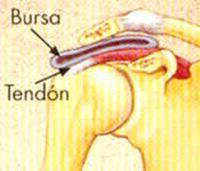 El Síndrome de Compresión Subacromial