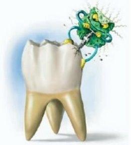 No Más Caries: Inventan Una Molécula Que Sanea La Boca