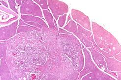 ¿Que son los Insulinomas?