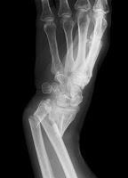 Osteoporosis Tratamiento