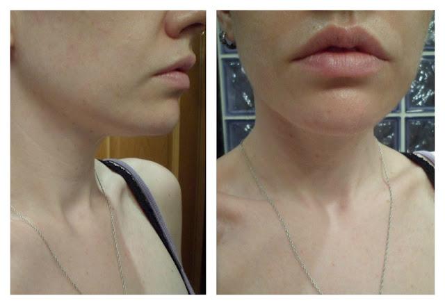 Perfect V Shaper, V Shaping Patch de BRTC