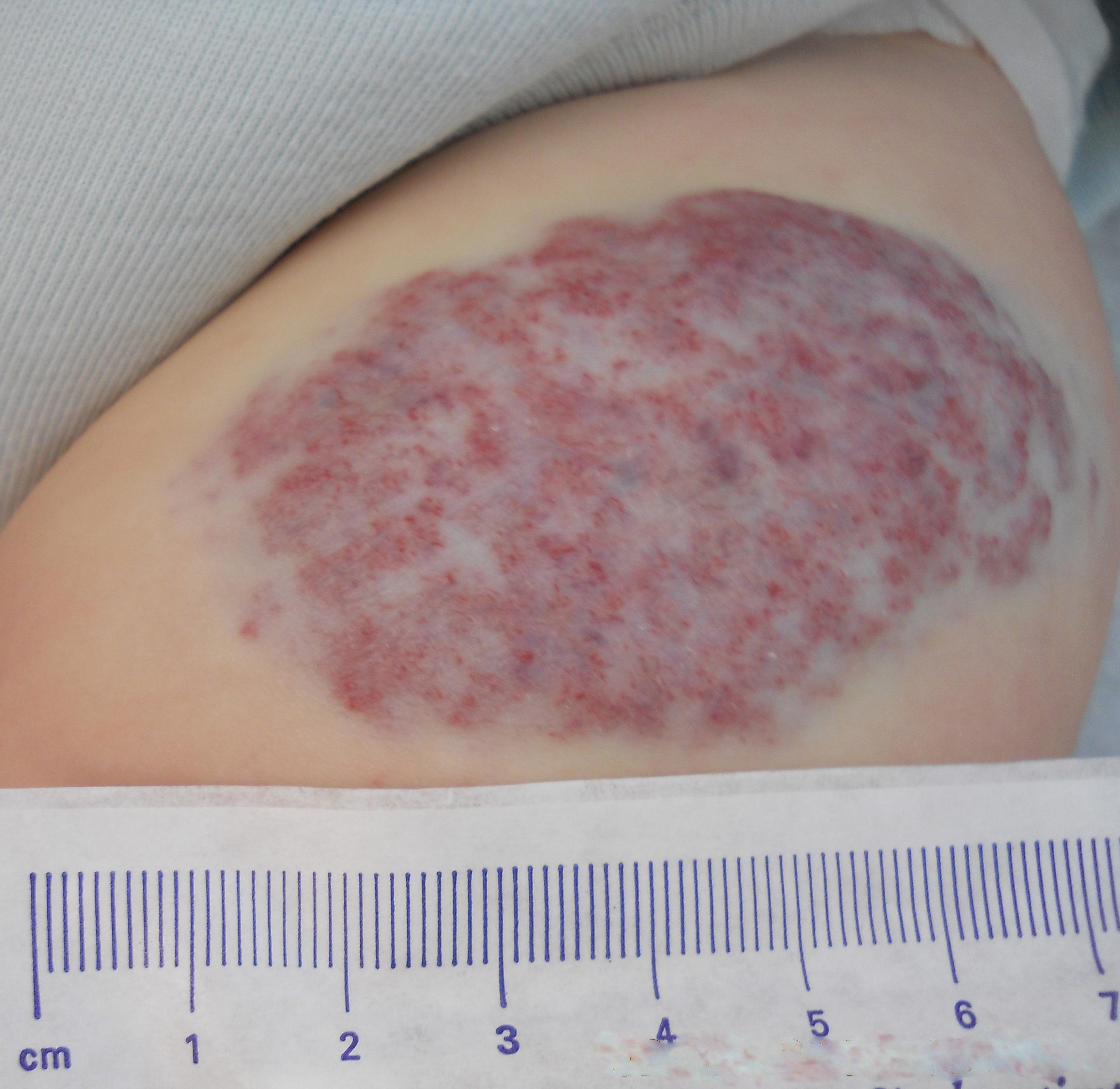 Los hemangiomas en los niños