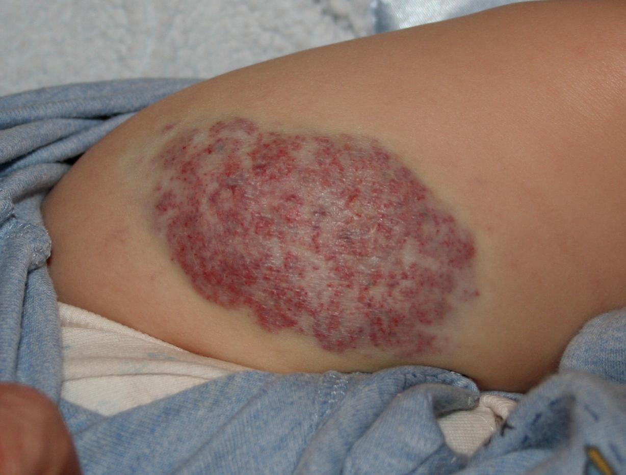 Los hemangiomas en los niños