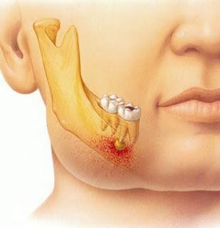 Dolor de muela por un Flemón Dental ¿Qué hacer?
