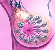 Acerca del cáncer de mama en el embarazo