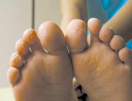 La enfermedad de Kawasaki