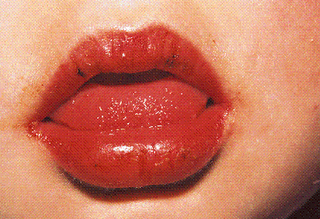 La enfermedad de Kawasaki