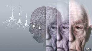 Fracasa prueba de droga para el Alzheimer