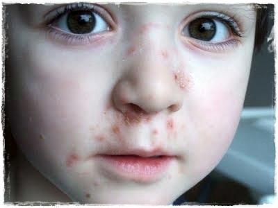 El impétigo en los niños