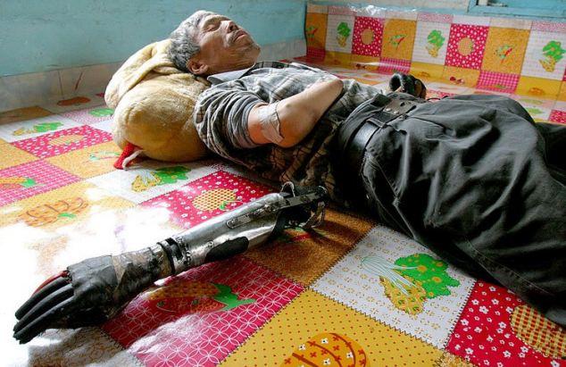 Imagen: Hombre Chino Inventa las Manos Biónicas