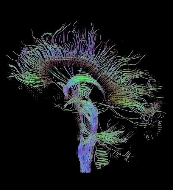 Neuroimagen (III): Resonancia magnética, funcional y Conectoma