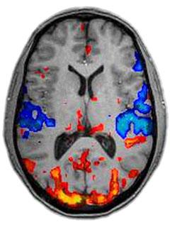 Neuroimagen (III): Resonancia magnética, funcional y Conectoma