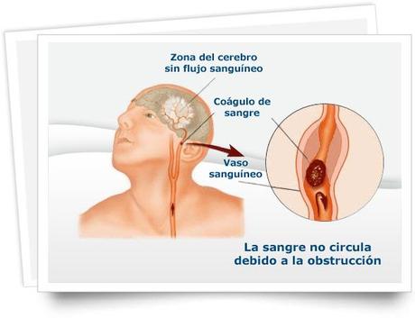 Reconocer un infarto cerebral