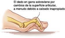 Soluciones a las deformidades de los dedos del pie
