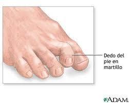 Soluciones a las deformidades de los dedos del pie