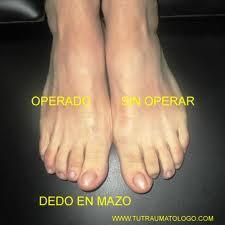 Soluciones a las deformidades de los dedos del pie
