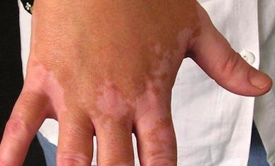Vitiligo: tratamientos naturales